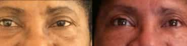 before and after Eyelid Surgery Colombia - Premium Care Plastic Surgery