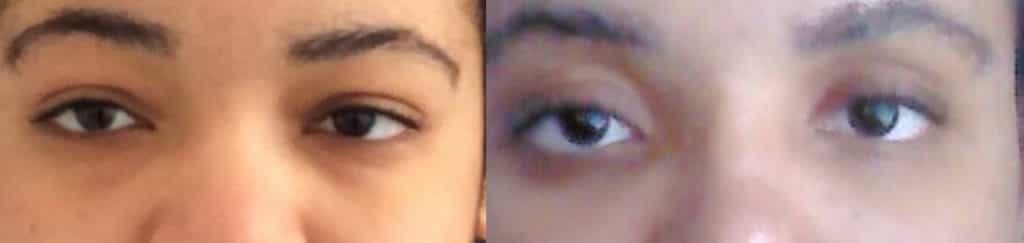 before and after Eyelid Surgery Colombia - Premium Care Plastic Surgery