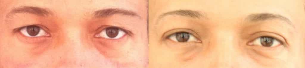 before and after Eyelid Surgery Colombia - Premium Care Plastic Surgery