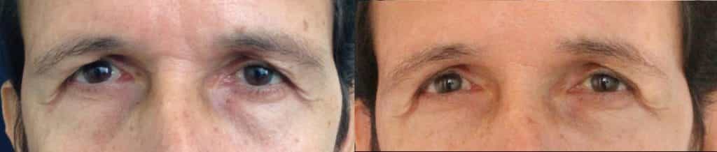 before and after Eyelid Surgery Colombia - Premium Care Plastic Surgery