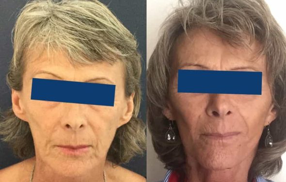 Facelift Colombia - Premium Care Plastic Surgery