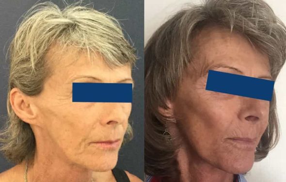 Facelift Colombia - Premium Care Plastic Surgery