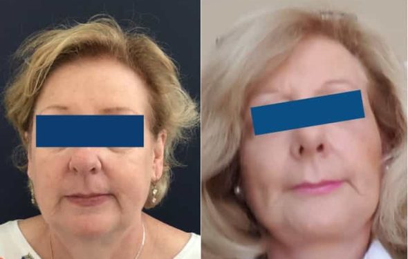 Before and After Facelift Colombia - Premium Care Plastic Surgery