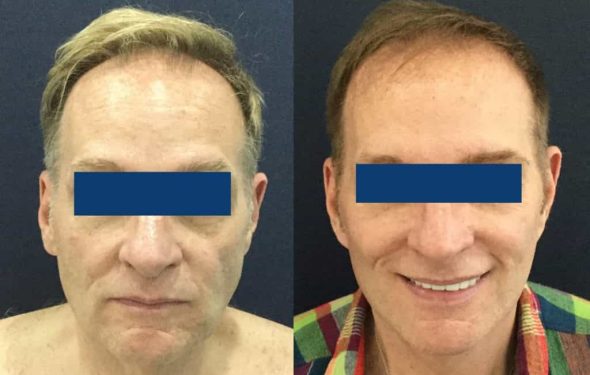 Facelift Colombia - Premium Care Plastic Surgery