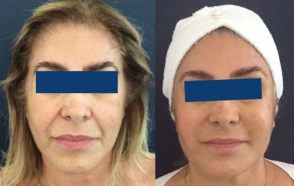 Before and After Facelift Colombia - Premium Care Plastic Surgery