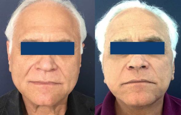 Facelift Colombia - Premium Care Plastic Surgery