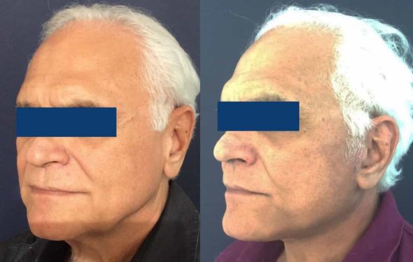 Facelift Colombia - Premium Care Plastic Surgery