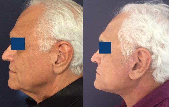 Facelift Colombia - Premium Care Plastic Surgery