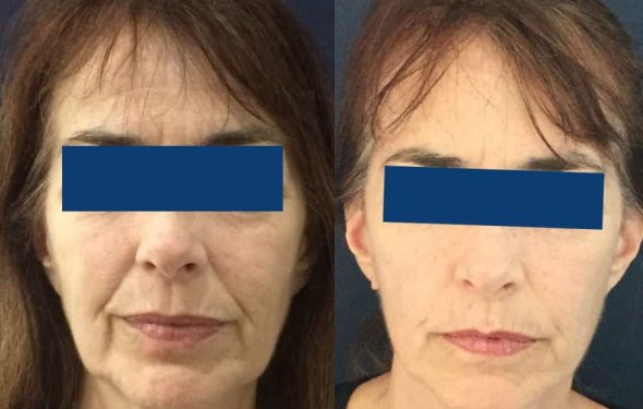 Facelift Colombia - Premium Care Plastic Surgery