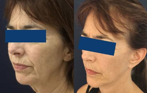 Facelift Colombia - Premium Care Plastic Surgery