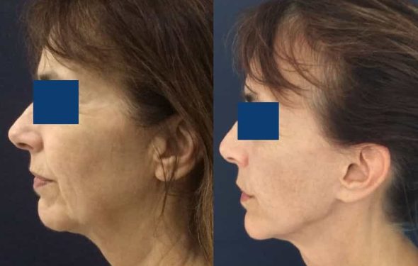 Facelift Colombia - Premium Care Plastic Surgery