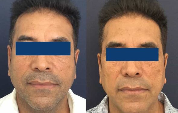 Facelift Colombia - Premium Care Plastic Surgery