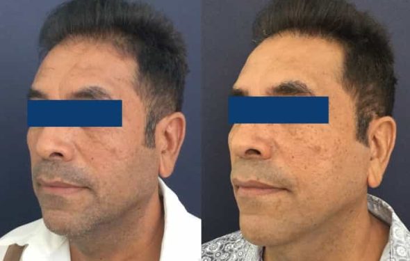 Facelift Colombia - Premium Care Plastic Surgery