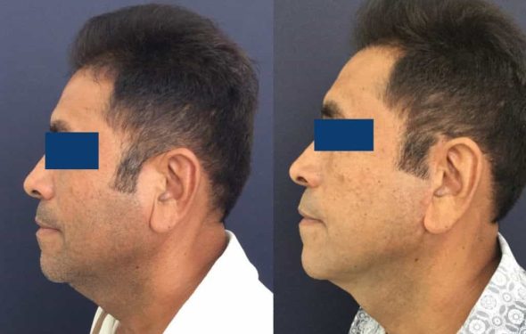 Facelift Colombia - Premium Care Plastic Surgery