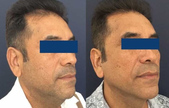 Facelift Colombia - Premium Care Plastic Surgery