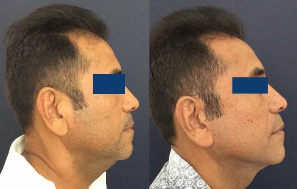 Facelift Colombia - Premium Care Plastic Surgery