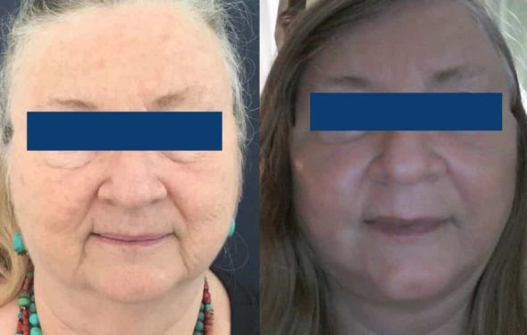 Facelift Colombia - Premium Care Plastic Surgery