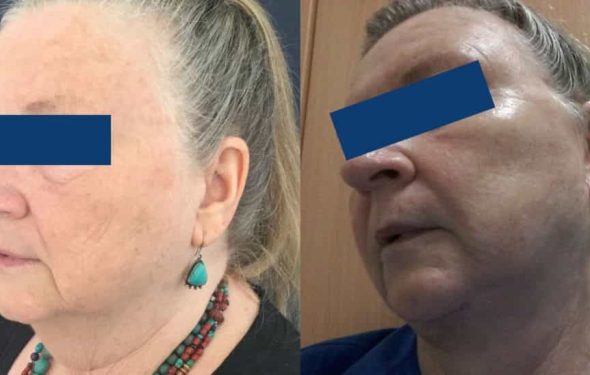 Facelift Colombia - Premium Care Plastic Surgery