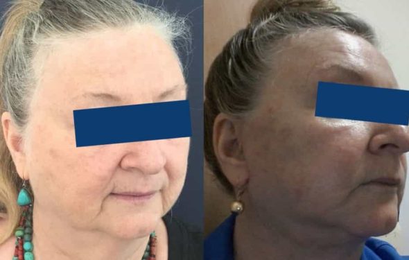 Facelift Colombia - Premium Care Plastic Surgery