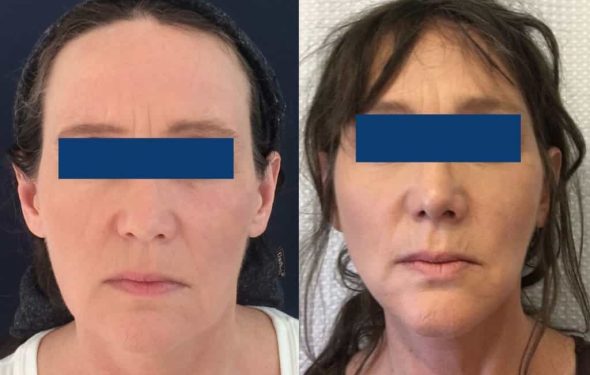 Facelift Colombia - Premium Care Plastic Surgery