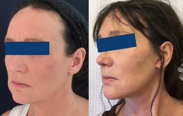 Facelift Colombia - Premium Care Plastic Surgery