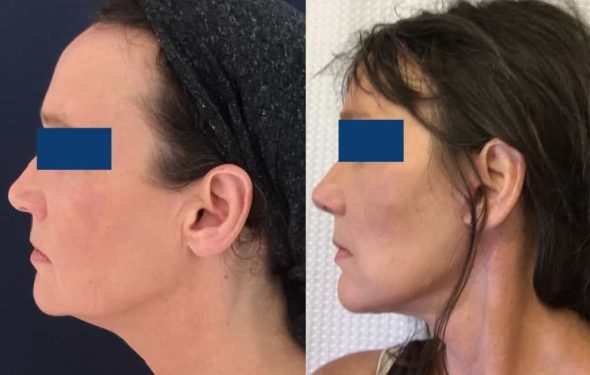 Facelift Colombia - Premium Care Plastic Surgery