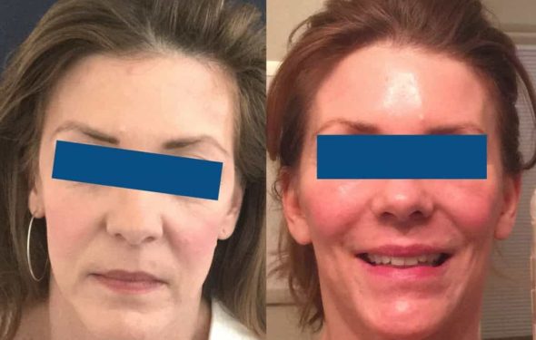 Facelift Colombia - Premium Care Plastic Surgery