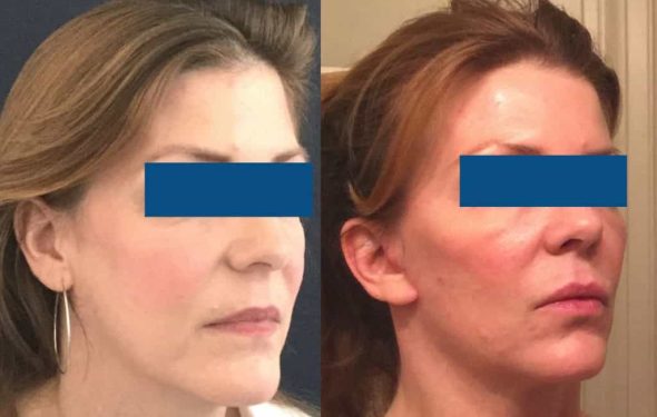 Facelift Colombia - Premium Care Plastic Surgery