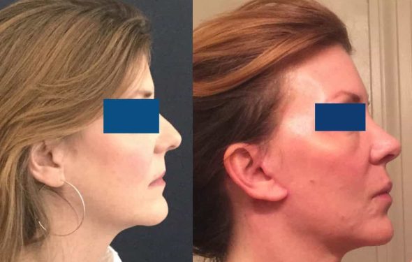 Facelift Colombia - Premium Care Plastic Surgery