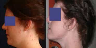Facial Fat Grafting Colombia - Premium Care Plastic Surgery