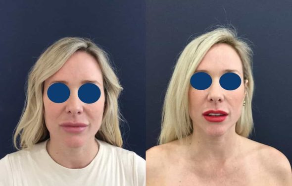 Before and after Facial Fat Grafting Colombia - Premium Care Plastic Surgery