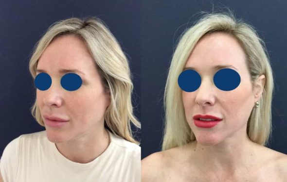 Before and after Facial Fat Grafting Colombia - Premium Care Plastic Surgery