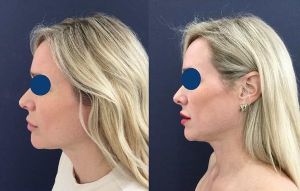 Before and after Facial Fat Grafting Colombia - Premium Care Plastic Surgery