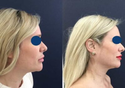 Before and after Facial Fat Grafting Colombia - Premium Care Plastic SurgeryFacial Fat Grafting Cartagena Colombia - Premium Care Plastic Surgery