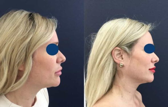 Before and after Facial Fat Grafting Colombia - Premium Care Plastic SurgeryFacial Fat Grafting Cartagena Colombia - Premium Care Plastic Surgery