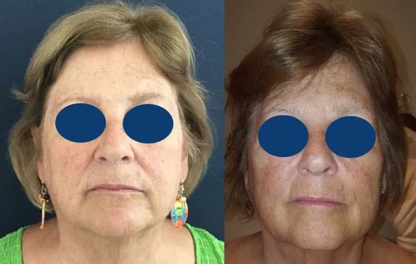 Before and after Facial Fat Grafting Colombia - Premium Care Plastic Surgery