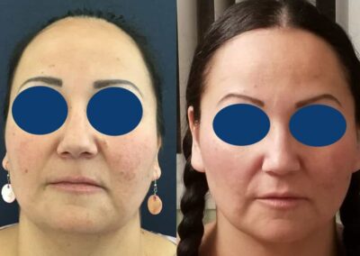 Before and after Facial Fat Grafting Colombia - Premium Care Plastic Surgery