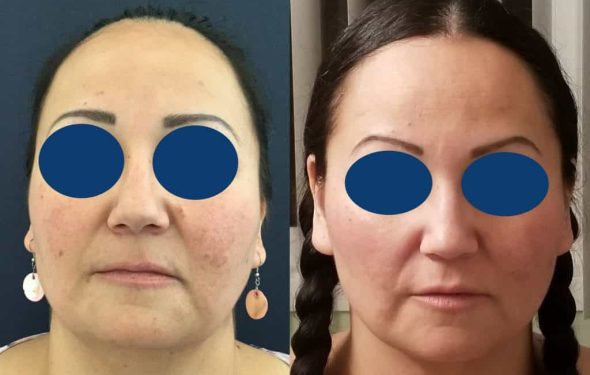 Before and after Facial Fat Grafting Colombia - Premium Care Plastic Surgery