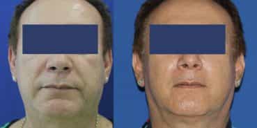 Facial Fat Grafting Colombia - Premium Care Plastic Surgery