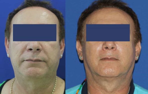 Facial Fat Grafting Colombia - Premium Care Plastic Surgery