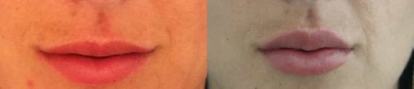 Lip Enhancement Colombia - Premium Care Plastic Surgery