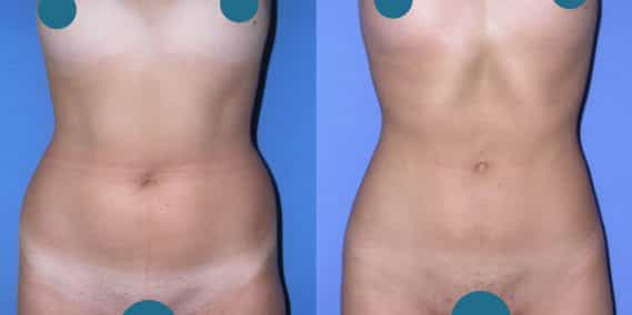 Before and After Liposuction Colombia - Premium Care Plastic Surgery