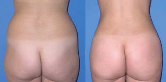 Before and After Liposuction Colombia - Premium Care Plastic Surgery