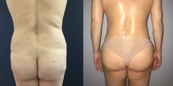Liposuction Colombia - Premium Care Plastic Surgery