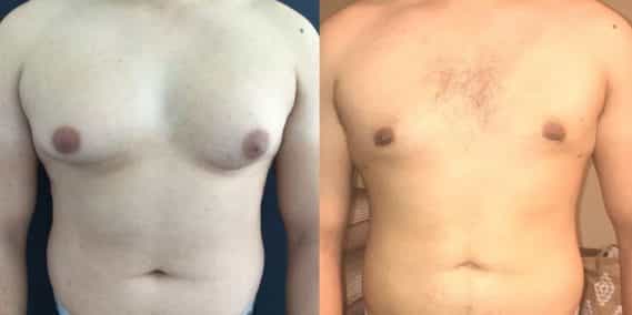 Liposuction Colombia - Premium Care Plastic Surgery