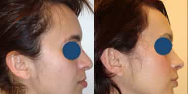 Before and After - Rhinoplasty Colombia - Premium Care Plastic Surgery