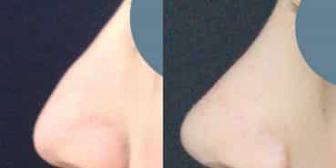 Before and After Rhinoplasty Colombia - Premium Care Plastic Surgery
