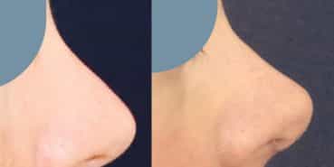 Before and After Rhinoplasty Colombia - Premium Care Plastic Surgery