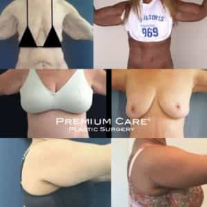 Arm Lift in Colombia - Premium Care Plastic Surgery