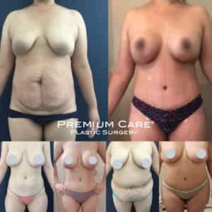 Breast Lift in Colombia - Premium Care Plastic Surgery